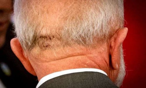 Lula dá entrada em hospital para resolver problema na cabeça