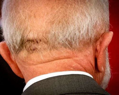 Lula dá entrada em hospital para resolver problema na cabeça