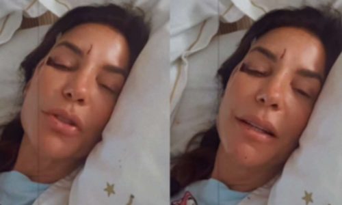 Ivete Sangalo é internada em hospital após desmaio e aparece com hematomas no rosto