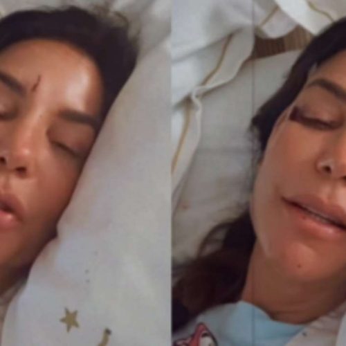 Ivete Sangalo é internada em hospital após desmaio e aparece com hematomas no rosto